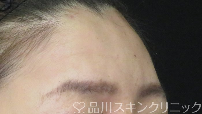 症例NO.71933のAFTER写真