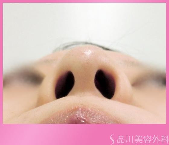 症例NO.1492のBEFORE写真