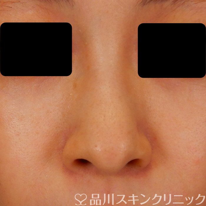 症例NO.69583のBEFORE写真