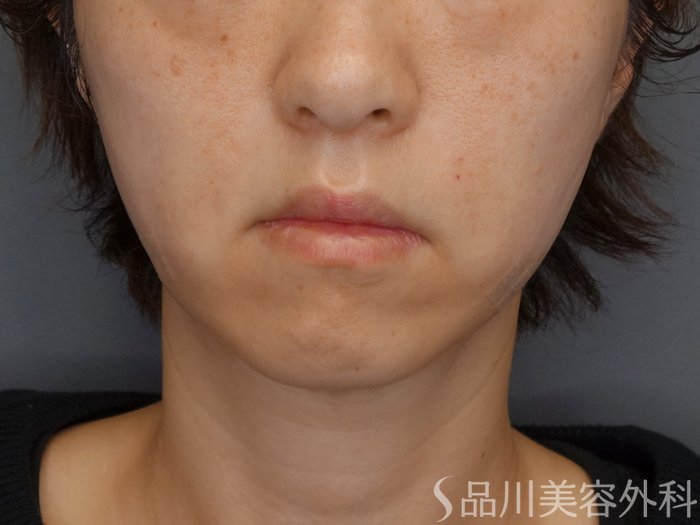 症例NO.72772のAFTER写真