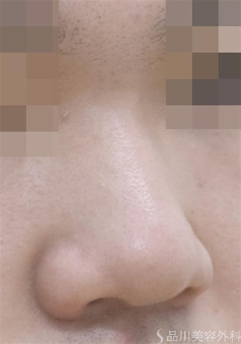 症例NO.47696のBEFORE写真