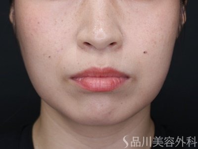 症例NO.71696のAFTER写真