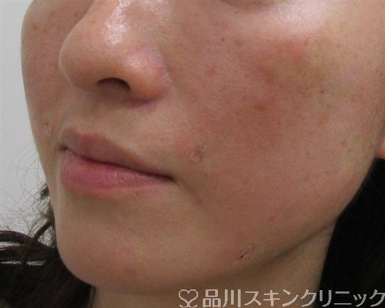 症例NO.38649のAFTER写真