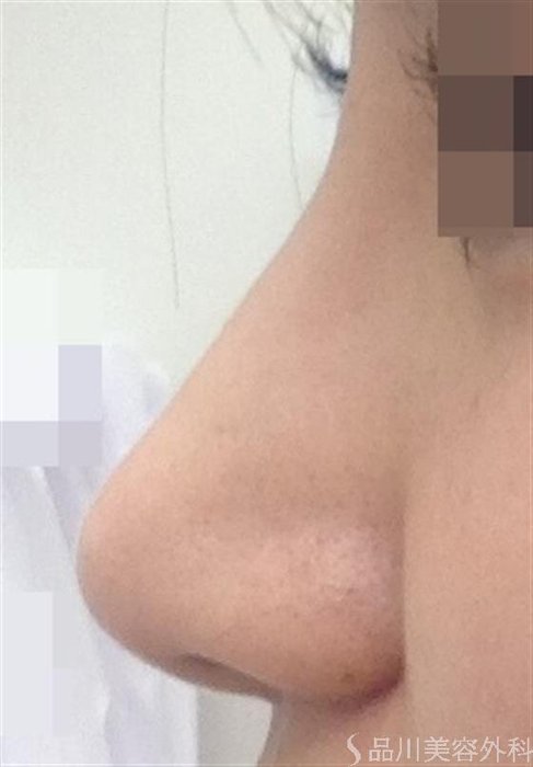 症例NO.43592のAFTER写真