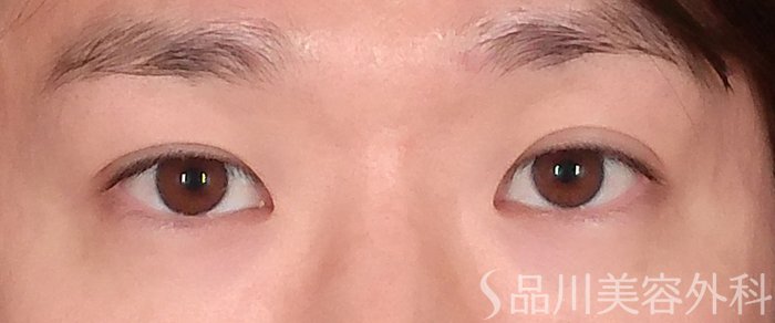 症例NO.72896のBEFORE写真