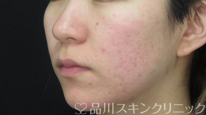 症例NO.71515のAFTER写真