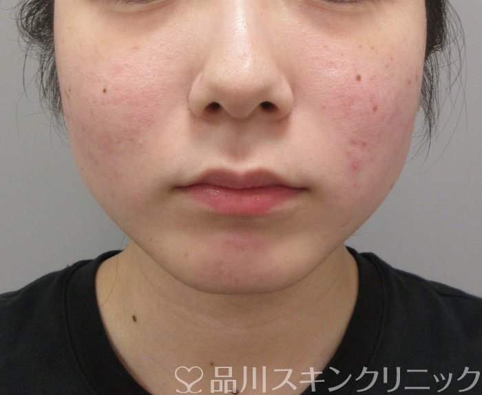 症例NO.73809のAFTER写真