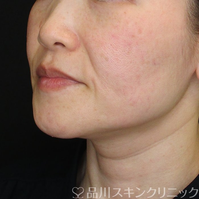 症例NO.73790のBEFORE写真