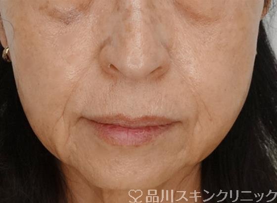 症例NO.49425のBEFORE写真