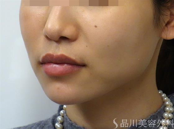 症例NO.39986のAFTER写真