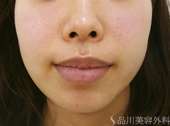 症例NO.23824のAFTER写真