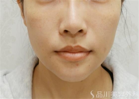 症例NO.38000のBEFORE写真