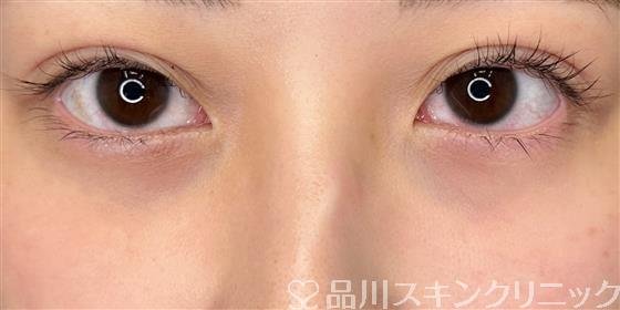 症例NO.61892のAFTER写真