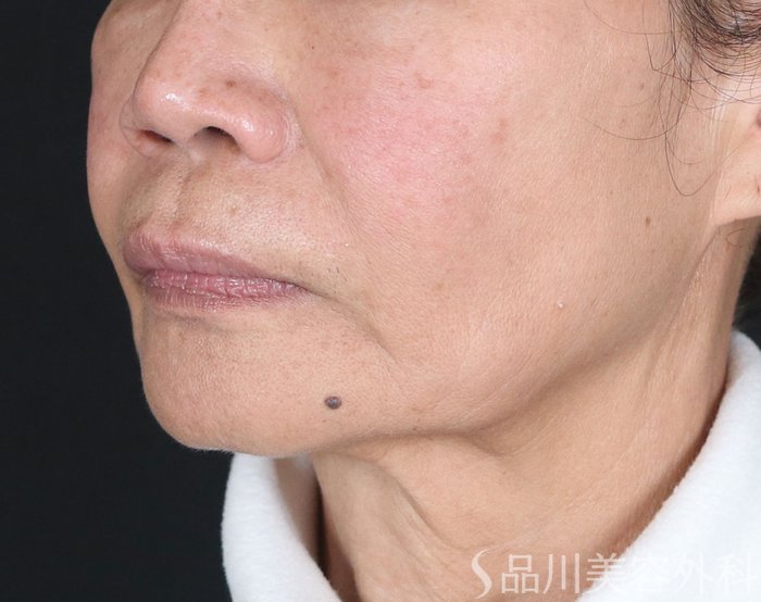 症例NO.72776のBEFORE写真