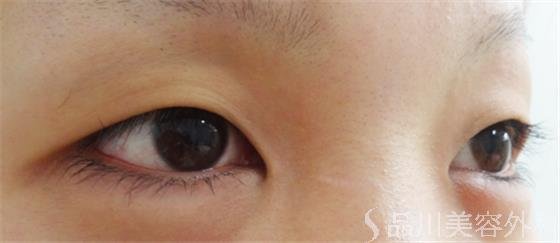 症例NO.23656のBEFORE写真