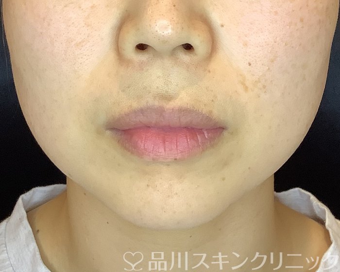 症例NO.70373のBEFORE写真
