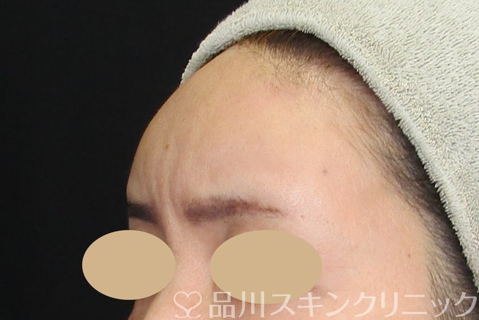 症例NO.74720のBEFORE写真