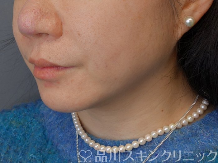 症例NO.72934のBEFORE写真