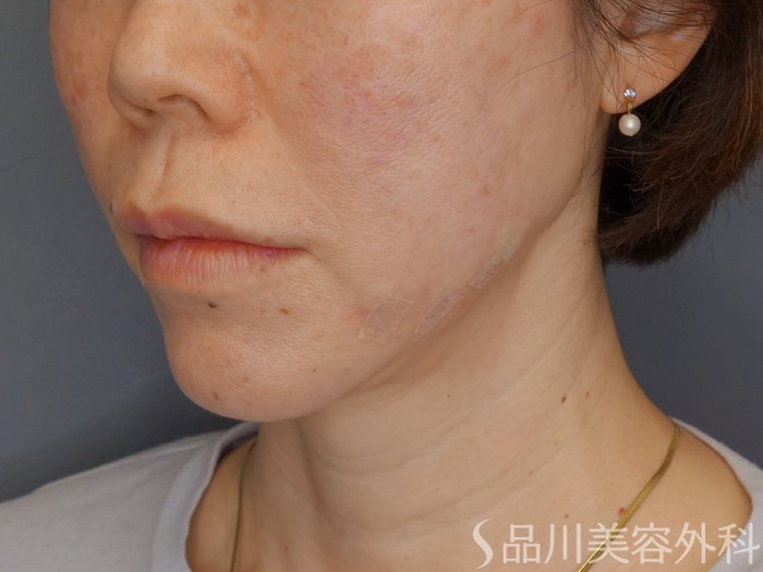 症例NO.72471のAFTER写真