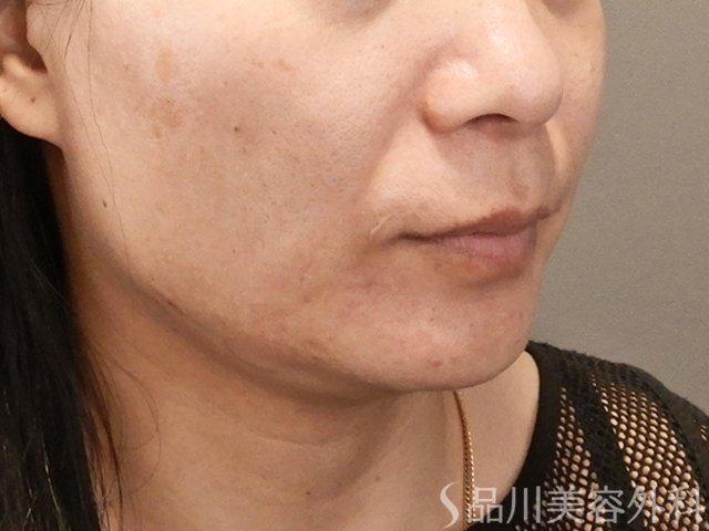 症例NO.75133のBEFORE写真