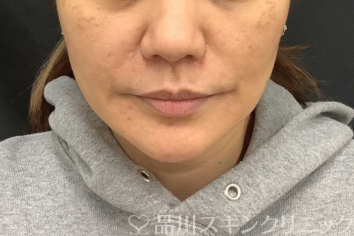 症例NO.69667のAFTER写真