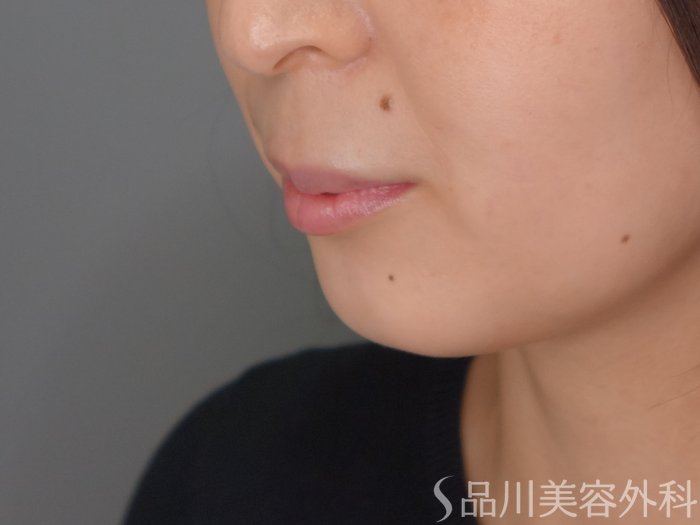 症例NO.70117のBEFORE写真