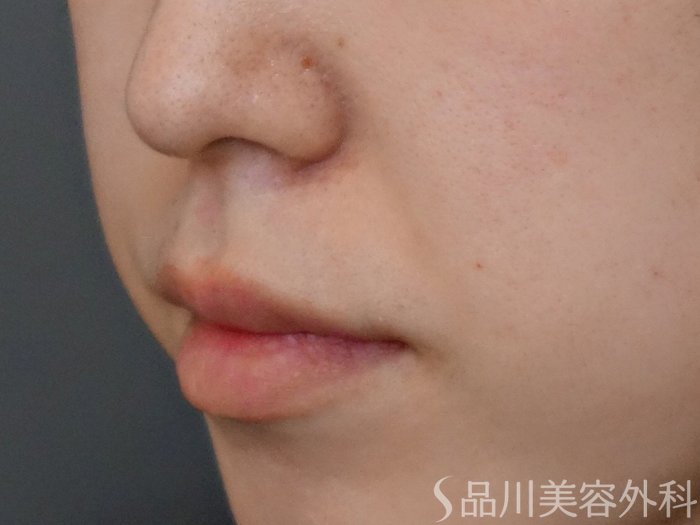 症例NO.67613のBEFORE写真