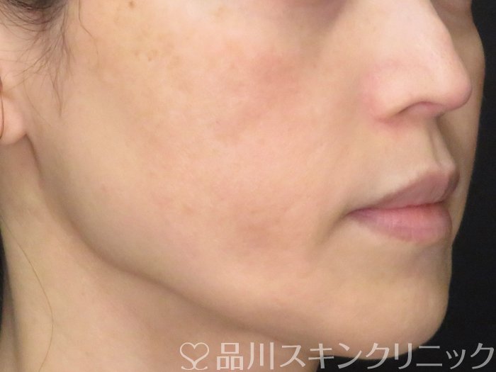 症例NO.70721のBEFORE写真
