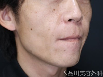 症例NO.75282のAFTER写真