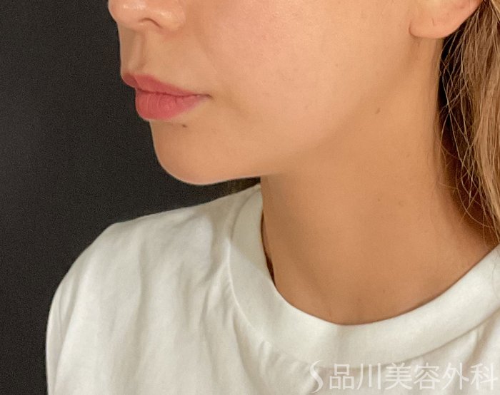 症例NO.74764のBEFORE写真