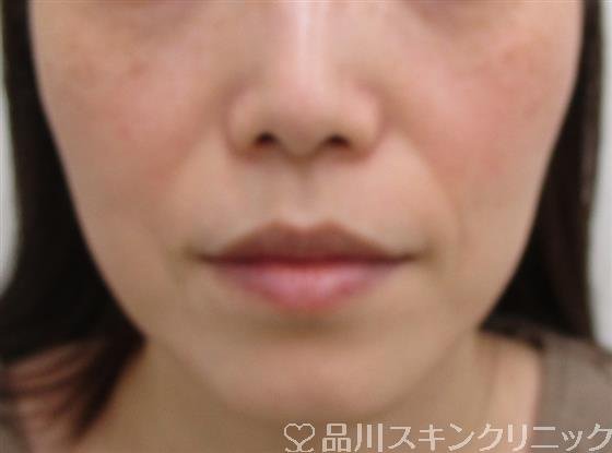 症例NO.41445のBEFORE写真