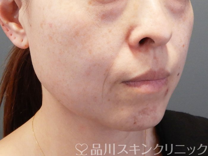 症例NO.72769のBEFORE写真