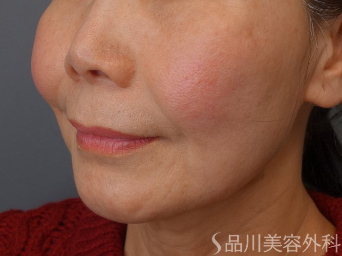 症例NO.73952のBEFORE写真