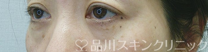 症例NO.69346のBEFORE写真