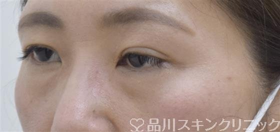 症例NO.54325のBEFORE写真