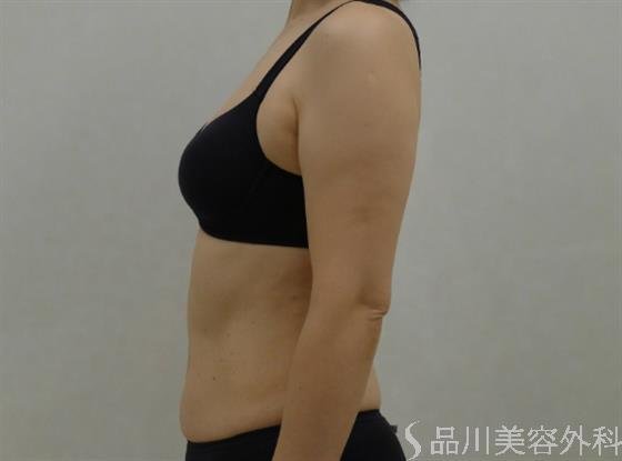 症例NO.34166のBEFORE写真