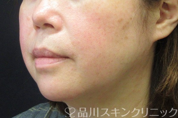 症例NO.67978のBEFORE写真