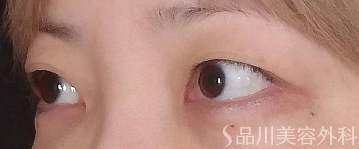 症例NO.70886のBEFORE写真