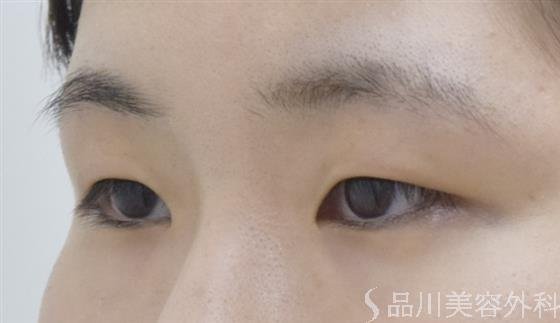症例NO.54040のBEFORE写真
