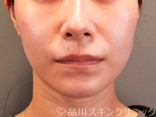 症例NO.70322のBEFORE写真