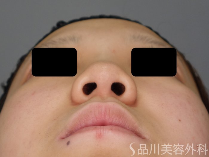 症例NO.74871のBEFORE写真