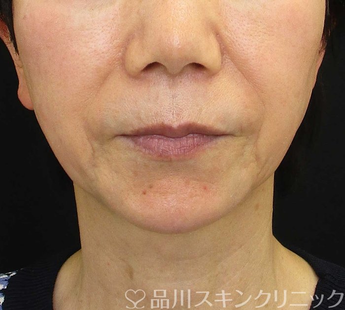 症例NO.70254のBEFORE写真
