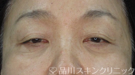 症例NO.72242のAFTER写真