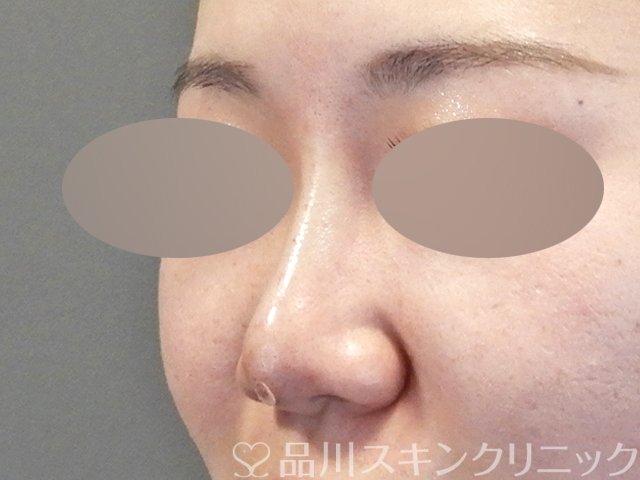 症例NO.64674のAFTER写真
