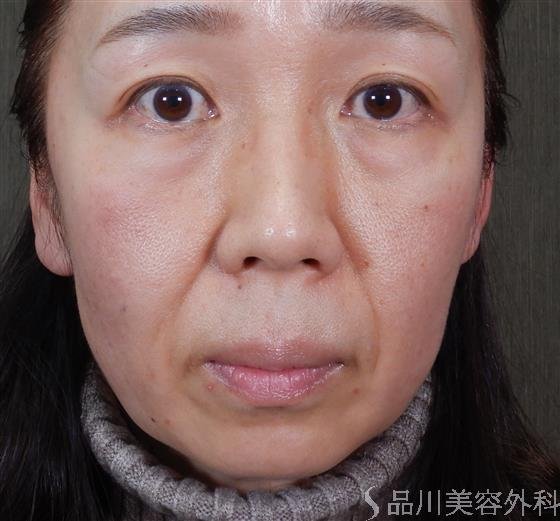 症例NO.59610のBEFORE写真
