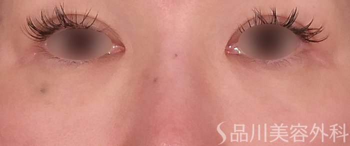 症例NO.69983のBEFORE写真