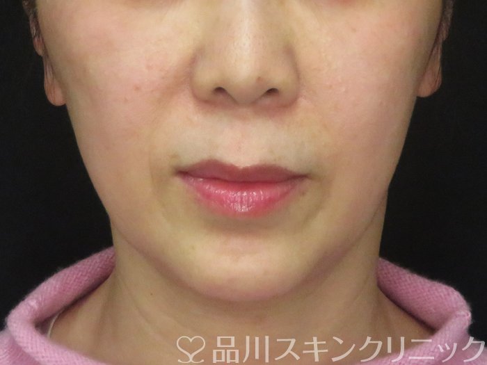 症例NO.67637のBEFORE写真