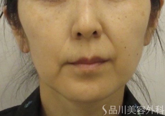 症例NO.74887のBEFORE写真