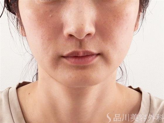 症例NO.60940のAFTER写真