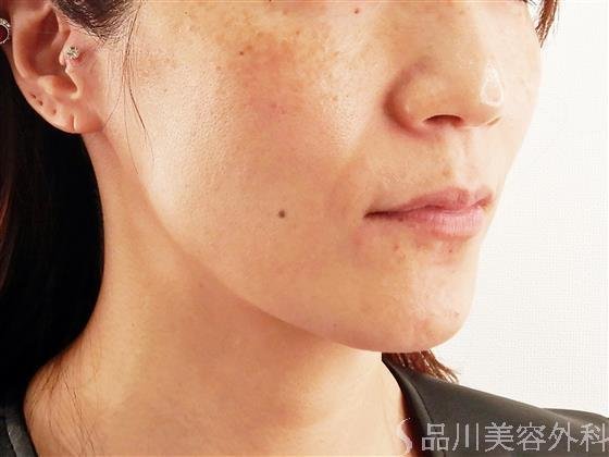 症例NO.56978のBEFORE写真